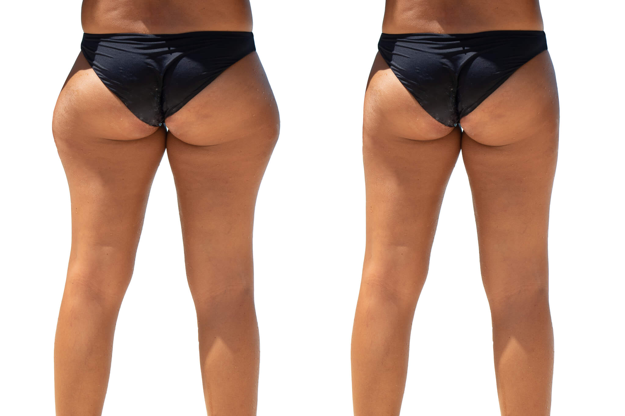 The Brazilian Butt Lift: Getting a Buttocks Augmentation Using Fat Grafting...