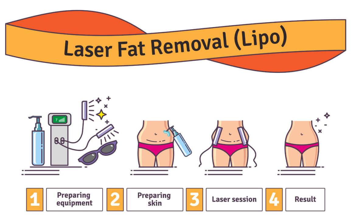 Where Does the Fat Go With Noninvasive Laser Lipo?