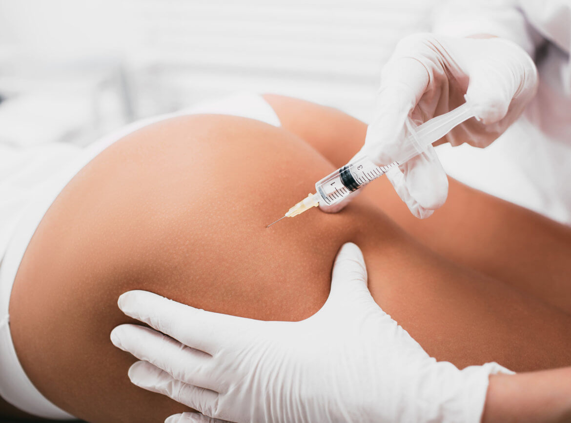 Sculptra Injections: Cost, Butt Lifts, Results, and More