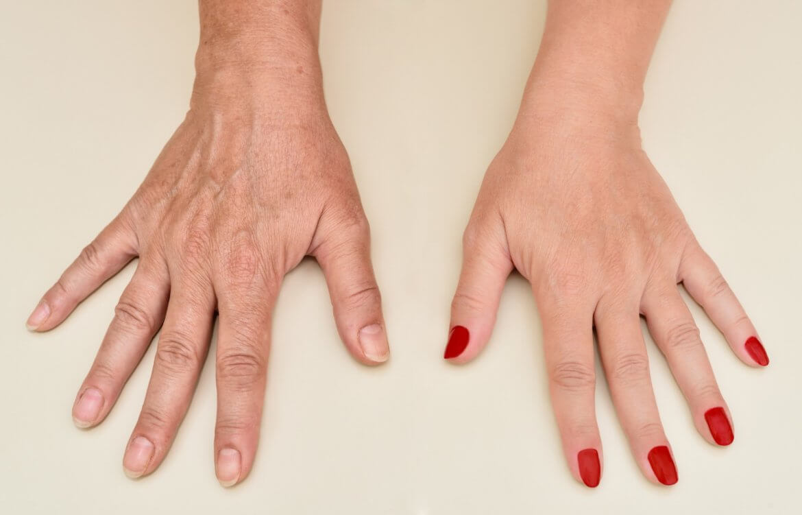 Hand Rejuvenation Procedures to Consider in 2021