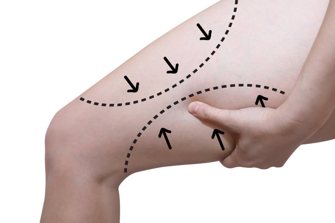 What Parts of the Leg Can Be Treated With Liposuction?